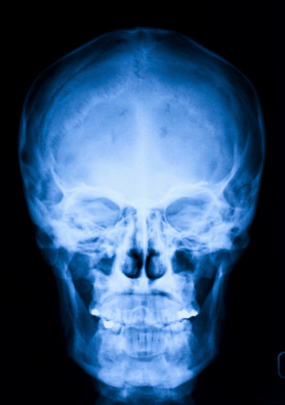 Skull X-Ray